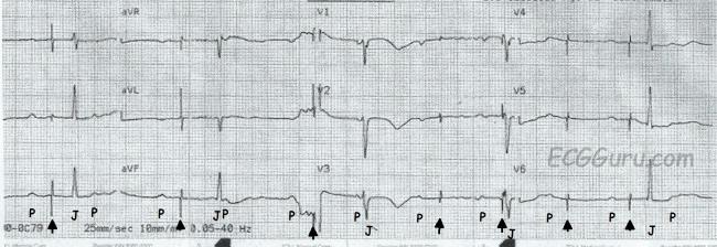Ecg Basics Pacemaker Failure To Capture Ecg Guru Instructor Resources Ecg Basics Pacemaker Failure To Capture Ecg Guru Instructor Resources